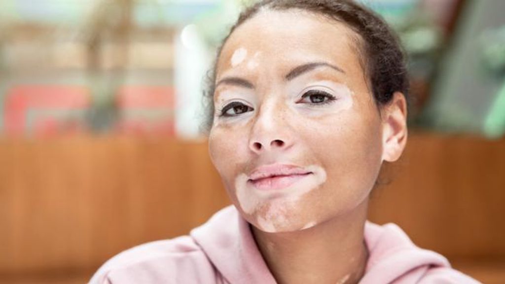 Maladie De Peau Vitiligo