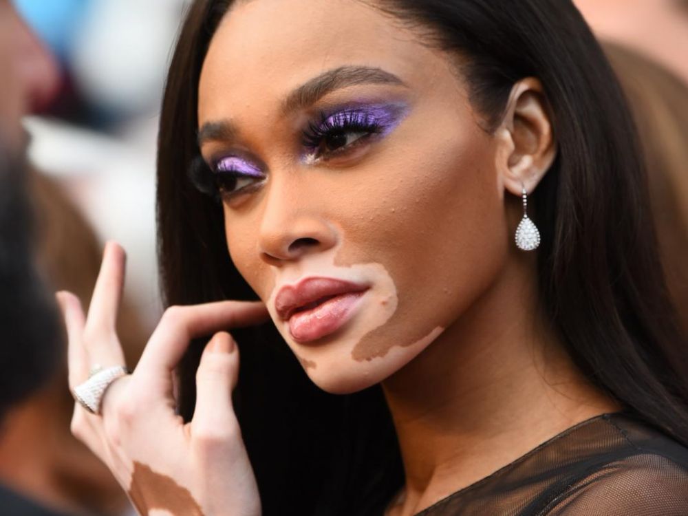 Maladie De Peau Vitiligo